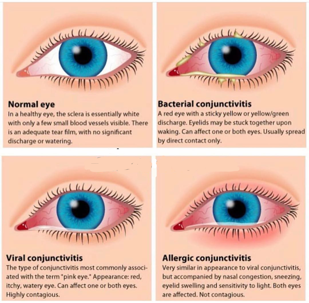Tipos de conjuntivitis Tipos de conjuntivitis